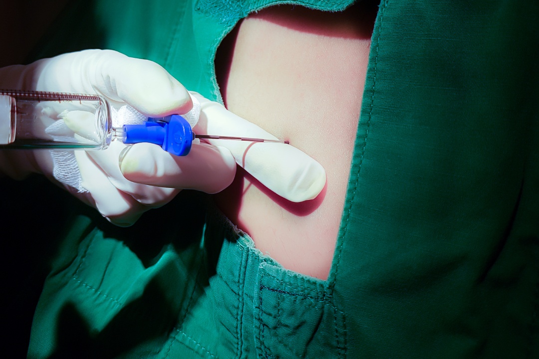 Anesthesiologist or doctor holding epidural needle on back of patient,Spinal anesthesia injections,Epidural anesthesia injections in preparation for a caesarean section,SOAT-for parturient.E.D.B