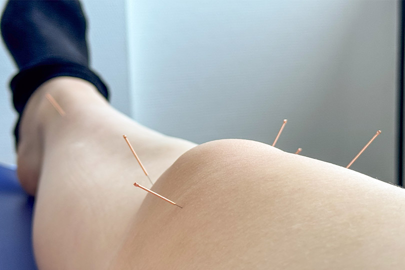 Image of acupuncture treatment targeting knee pain, emphasizing natural approaches for winter weather relief.
