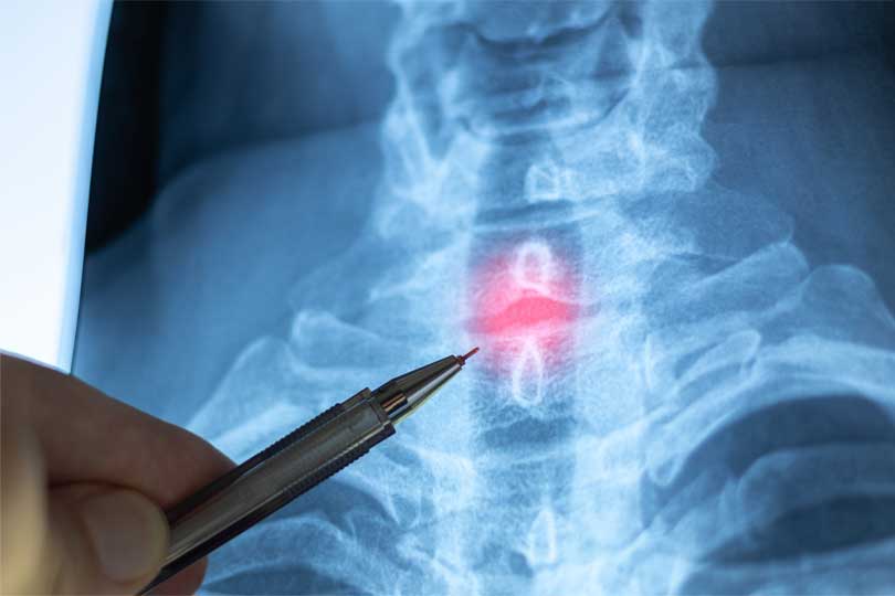 Doctor examining X-ray with cervical lordosis. P-signs of osteochondrosis of the cervical spine. Spondylosis, spondyloarthrosis.